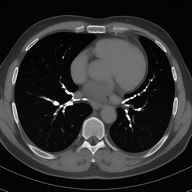 coronary calcium CT scan